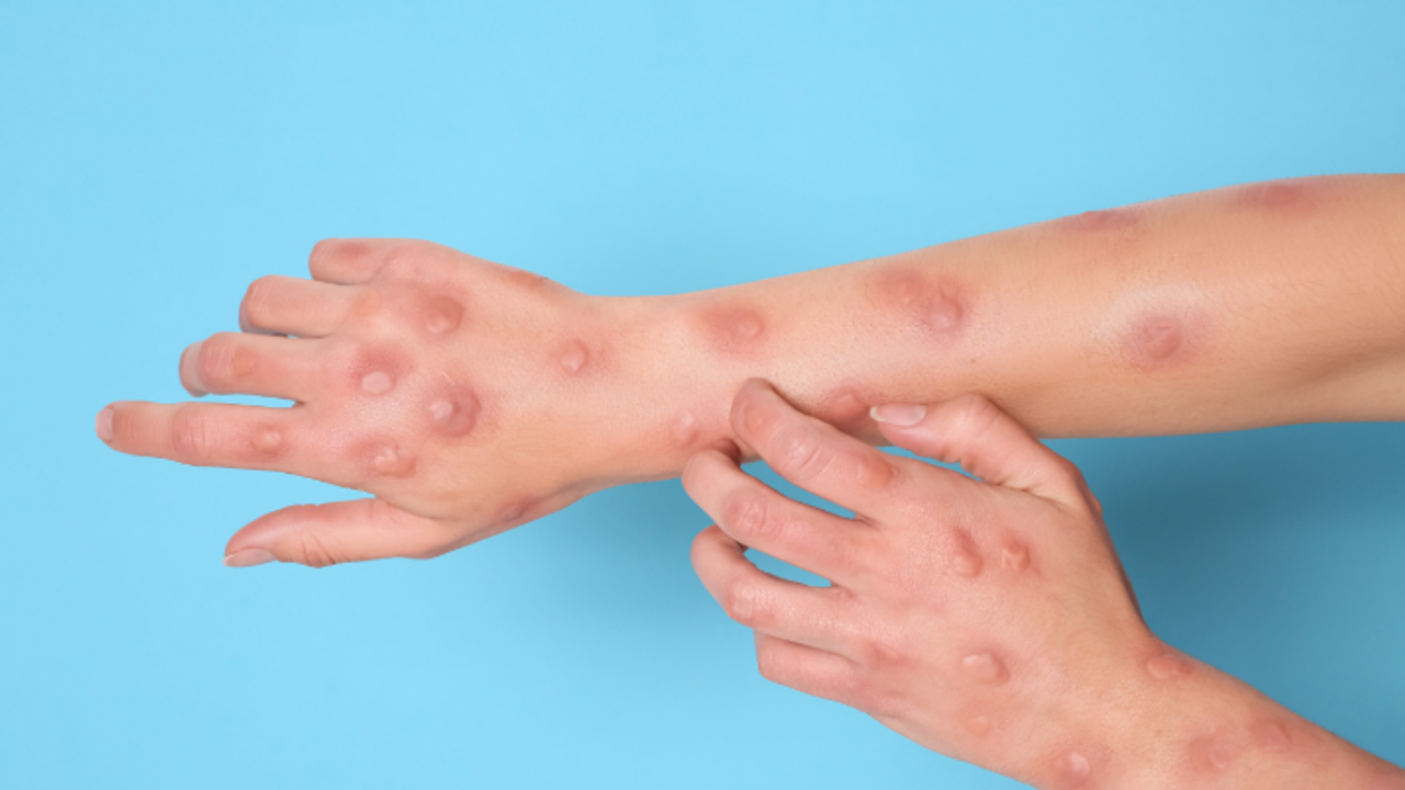 Maymun Çiçeği Varyantı Alanya'da Tehlike Yarattı