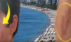 Vatandaşlar Tedirgin! Antalya’da Denize Giren Yanıklarla Çıkıyor
